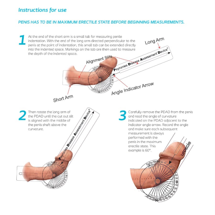 Peyronie’s Disease Assessment Device